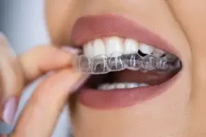 Invisalign Clear Aligners Milpitas